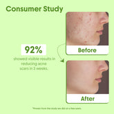 100% Pure Tea Tree & Rosemary Essential Oil for Skin, Scalp & Hair Care
