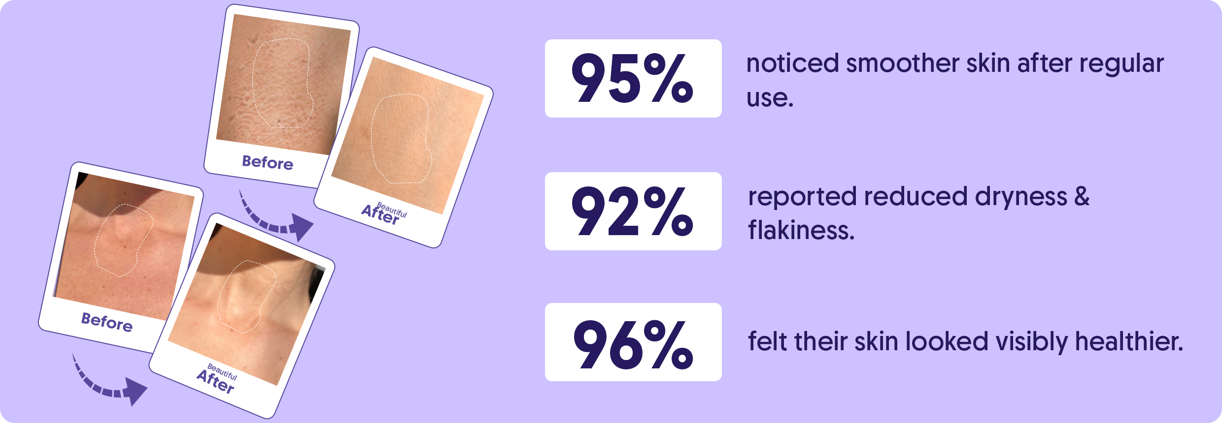 10% AHA + 1% BHA Body Lotion For Exfoliation - 200ml – Aravi Organic