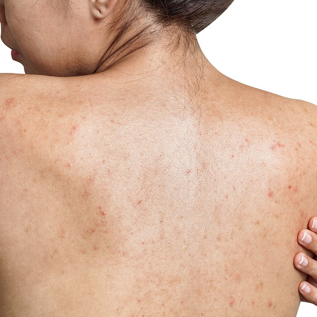 Body Acne & Bumps