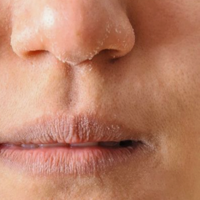 Dry & Dull Skin