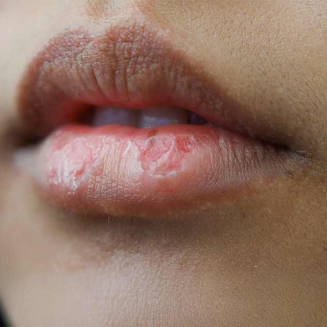 Dry & Pigmented Lips