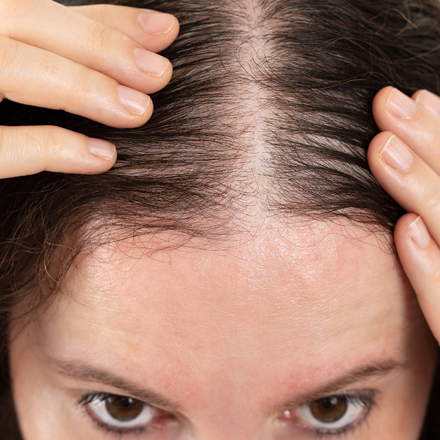 Hair Fall & Thinning
