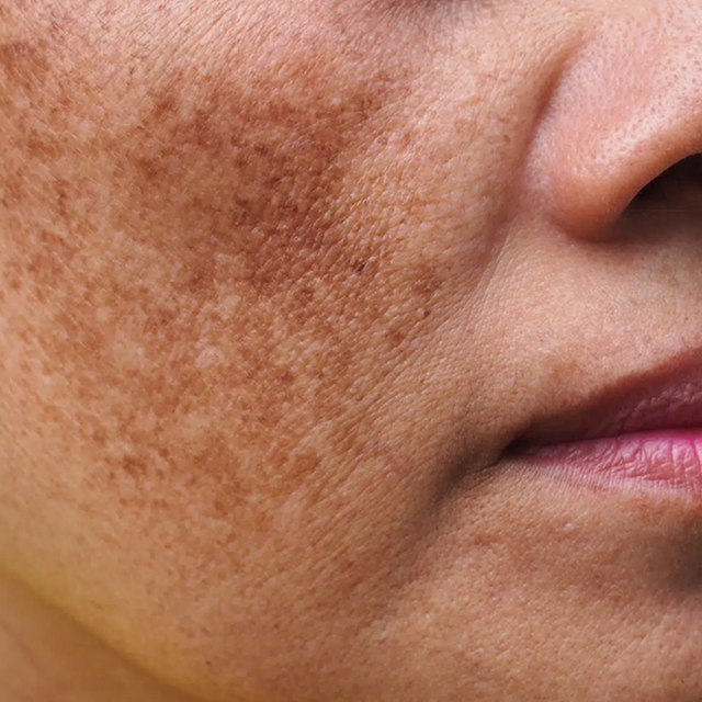 Pigmentation