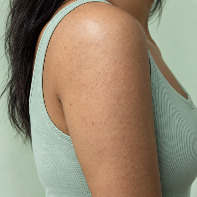 Body Acne & Bumps